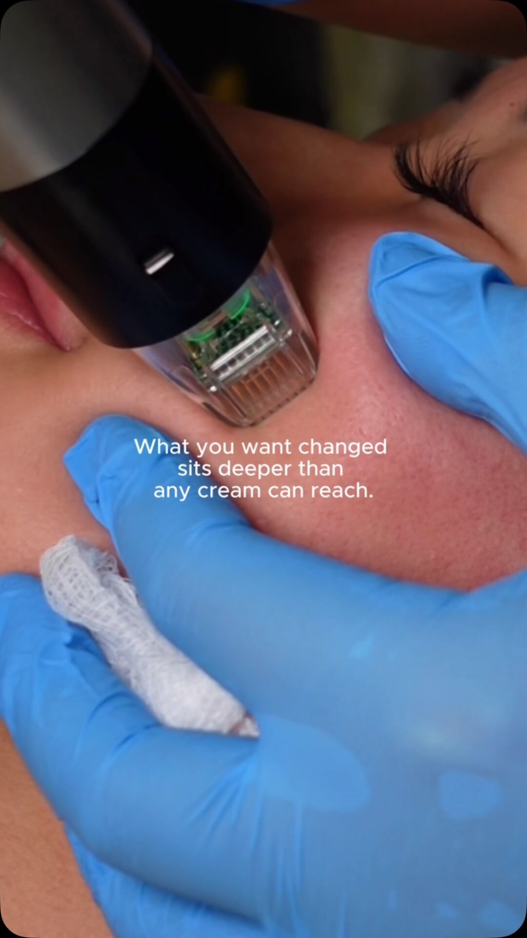The ultimate hack for getting more out of your microneedling session. Most people don’t even know this window exists.