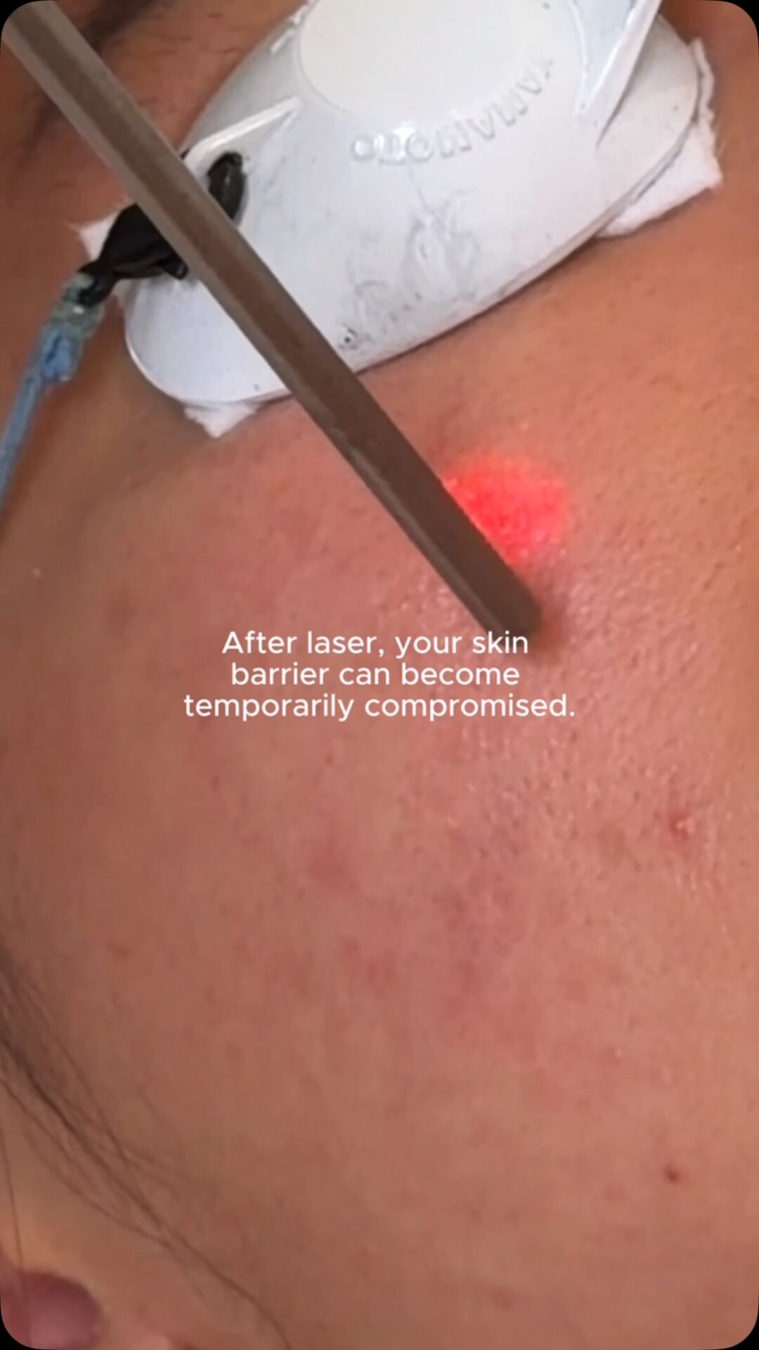 post-laser isn’t the time to experiment with your skincare routine. here’s how to help your skin recover without the