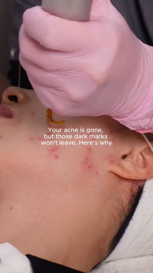 you finally cleared the acne, then realised the marks became the next problem.
