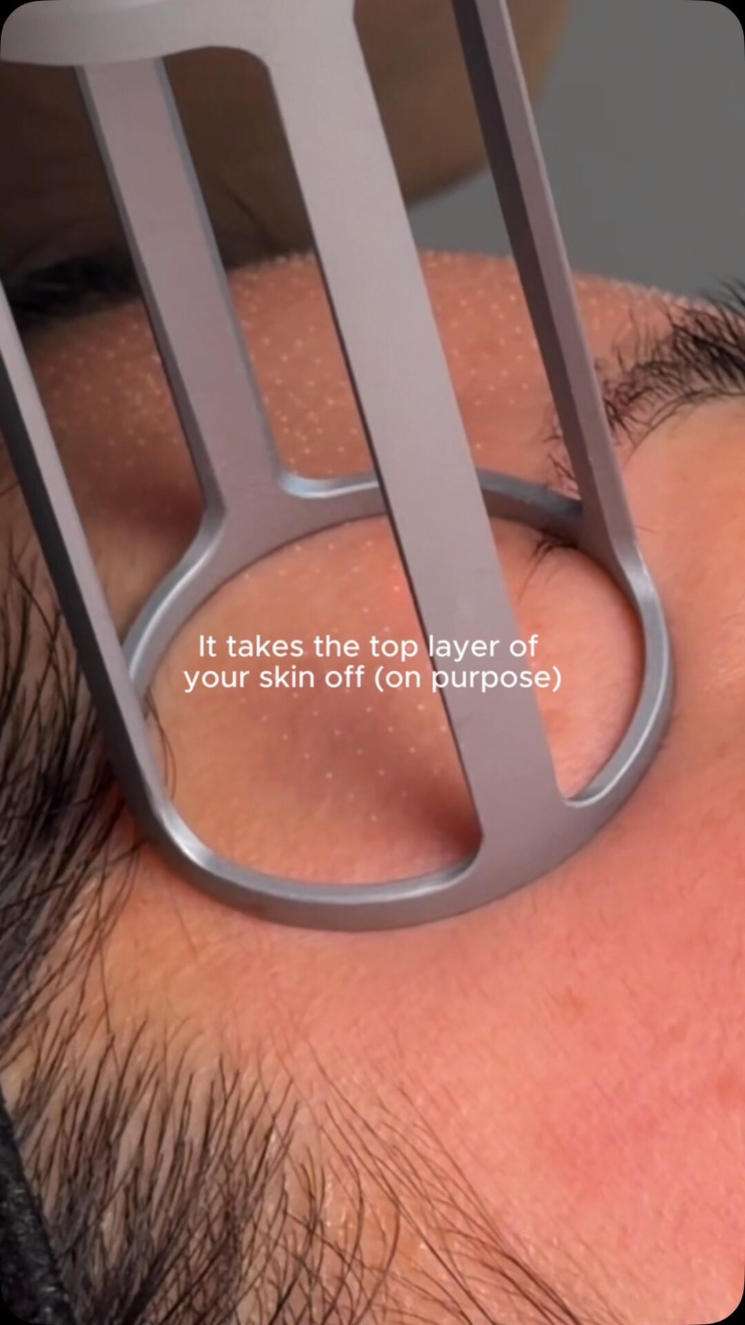 here’s why people are burning off the top layer of their skin- on purpose.